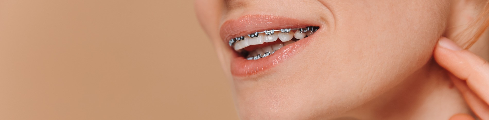 AdobeStock_759656572 v3 Woman showing of her beautiful straightened smile with Braces in New York