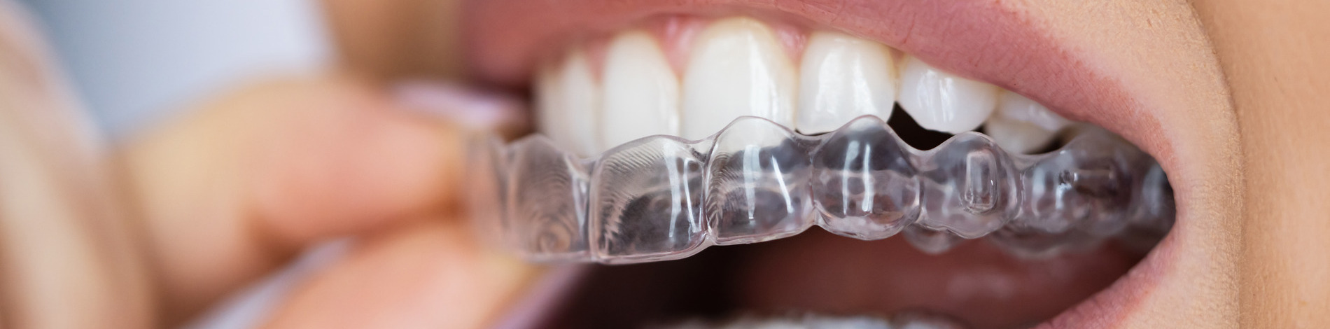 Woman showing of her beautiful straightened smile with Braces in New York