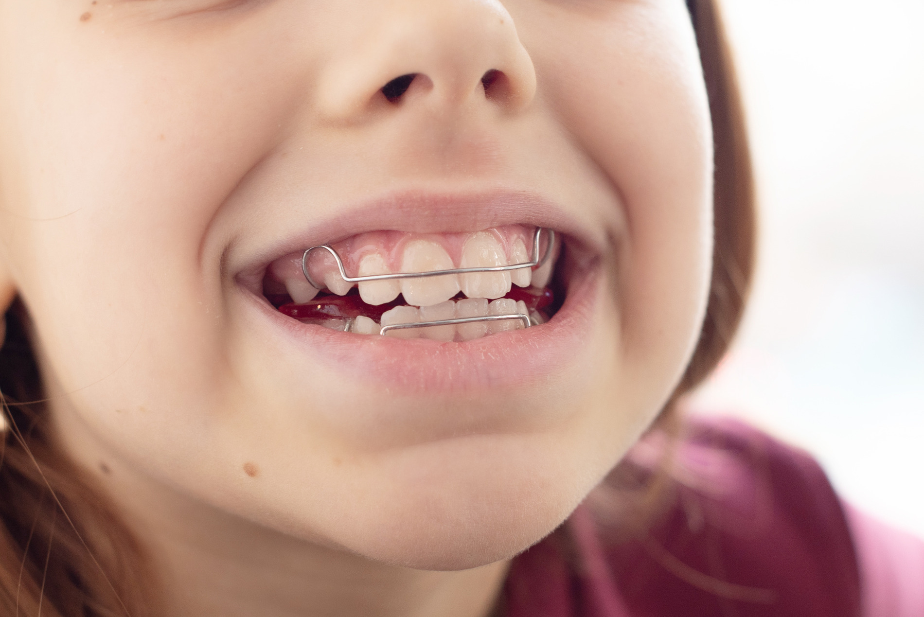 Girl showing off her phase one orthodontic treatment from Modern Orthodontics