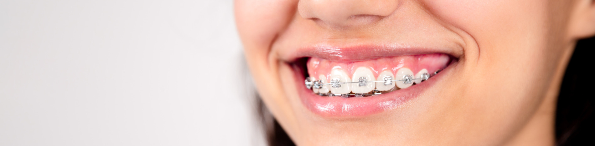 Girl on her two phase ortho treathment in New York