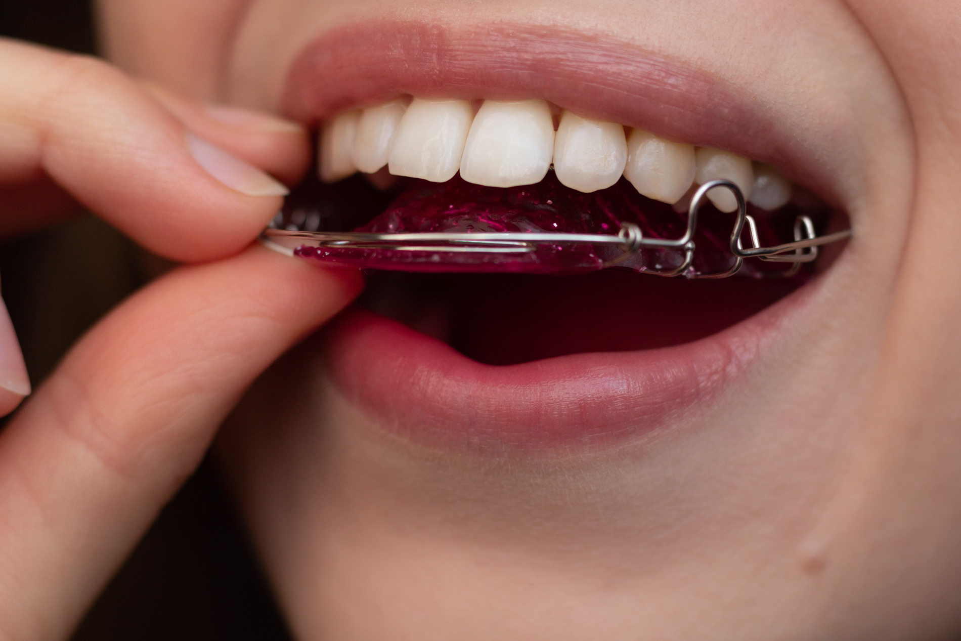 Girl places in her metal retainers in New York New York