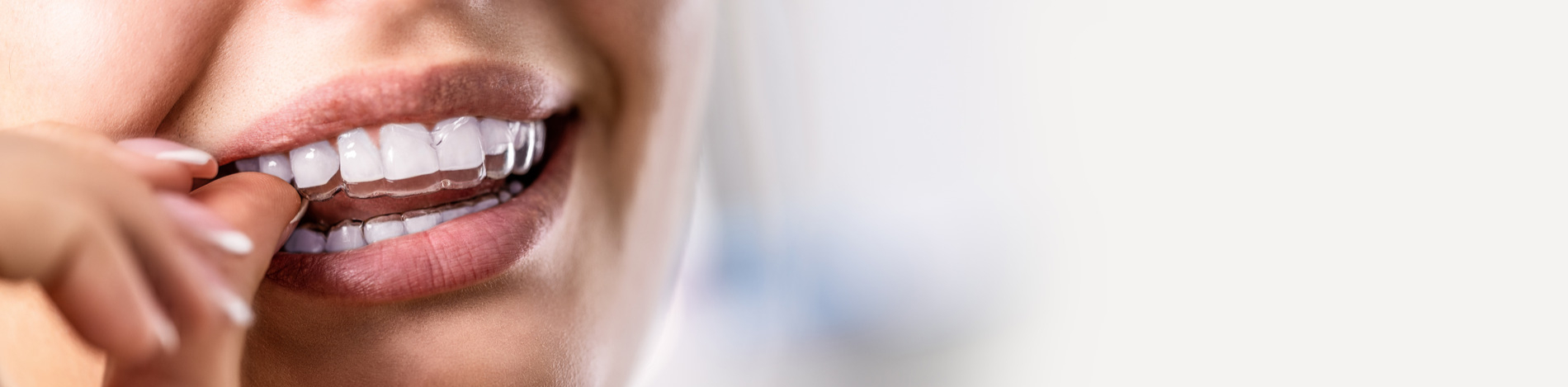 AdobeStock_538586238 v3 Woman putting in her clear retainers in New York
